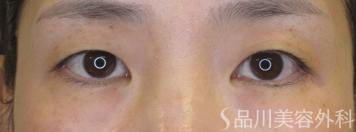 症例NO.70982のBEFORE写真
