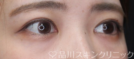 症例NO.70326のAFTER写真