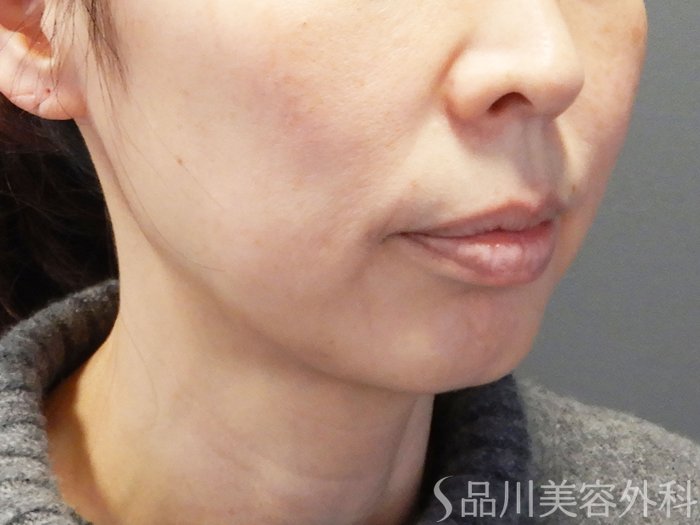 症例NO.74624のAFTER写真