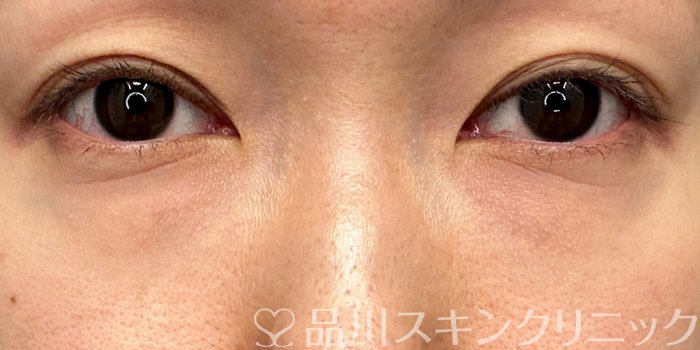 症例NO.64951のBEFORE写真