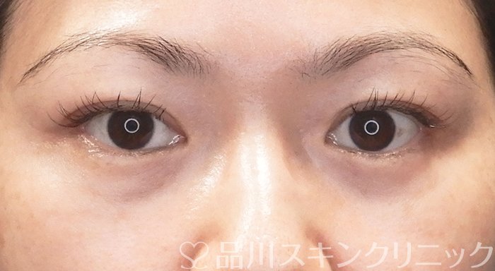 症例NO.69558のAFTER写真