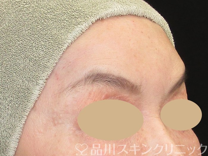 症例NO.74206のAFTER写真