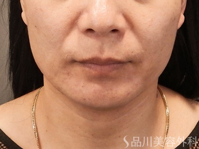 症例NO.75133のBEFORE写真