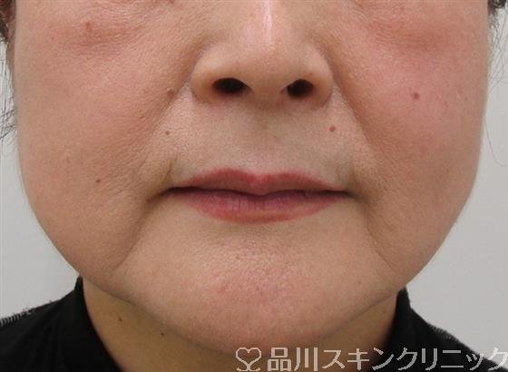 症例NO.42238のBEFORE写真