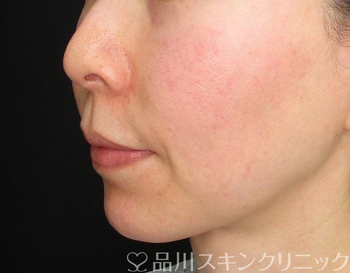 症例NO.73701のBEFORE写真