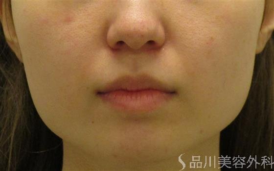 症例NO.58290のBEFORE写真