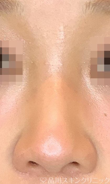 症例NO.72796のAFTER写真