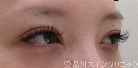 症例NO.42069のAFTER写真