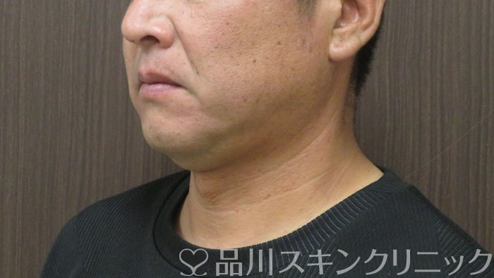 症例NO.72371のBEFORE写真