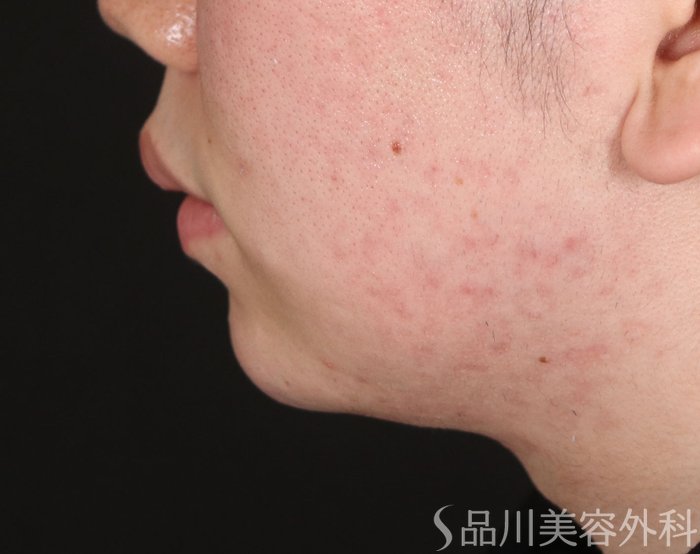 症例NO.73757のBEFORE写真