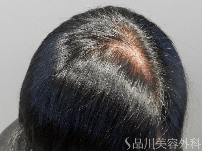 症例NO.69781のBEFORE写真