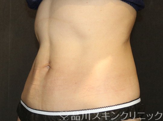 症例NO.70335のAFTER写真
