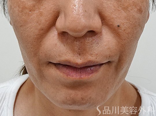 症例NO.65604のBEFORE写真
