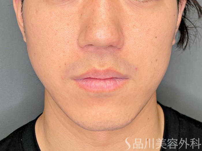 症例NO.73657のBEFORE写真