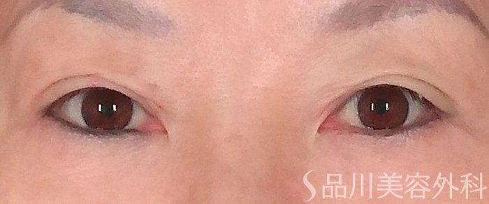 症例NO.71548のBEFORE写真