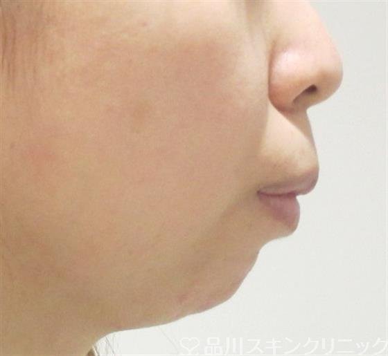症例NO.35557のBEFORE写真
