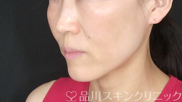 症例NO.72273のBEFORE写真