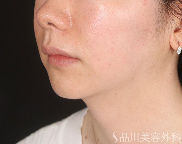 症例NO.73736のAFTER写真