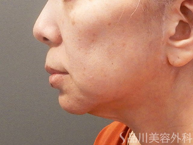 症例NO.72187のBEFORE写真