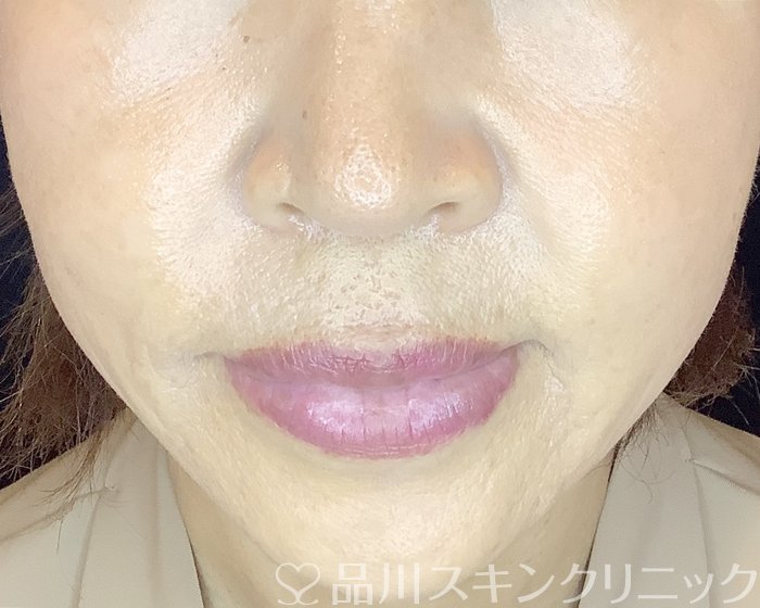 症例NO.66506のAFTER写真