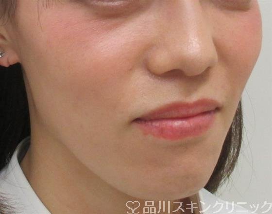 症例NO.29709のBEFORE写真