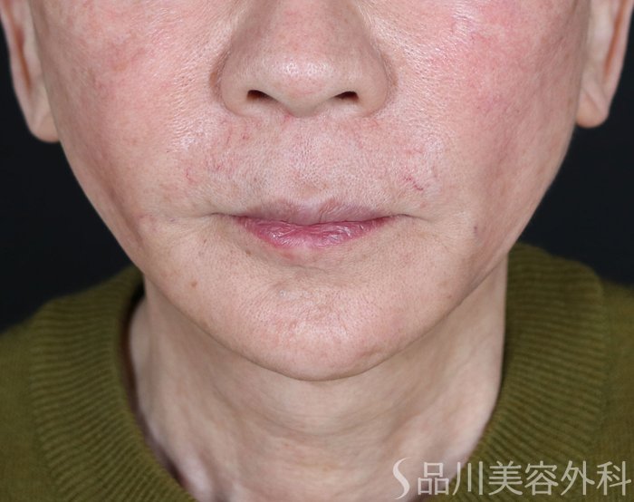 症例NO.73616のAFTER写真