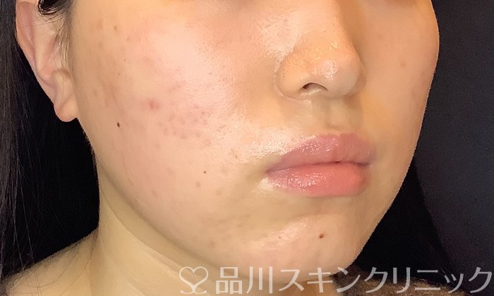 症例NO.74184のAFTER写真