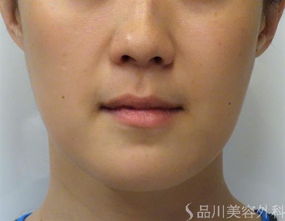 症例NO.39105のAFTER写真