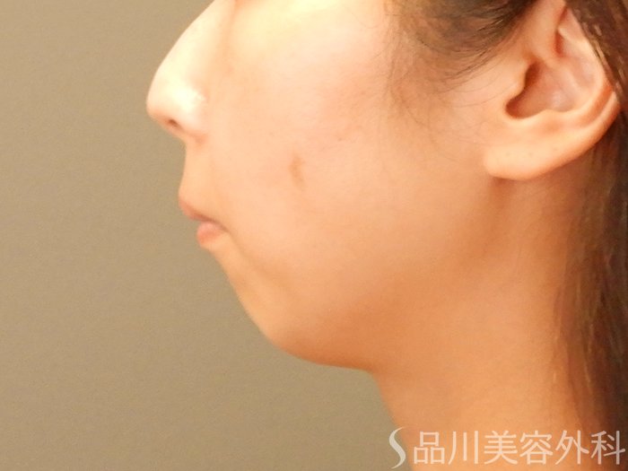 症例NO.66234のBEFORE写真