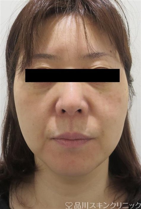 症例NO.33185のBEFORE写真
