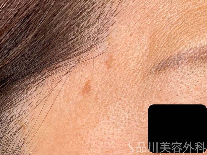 症例NO.65548のBEFORE写真