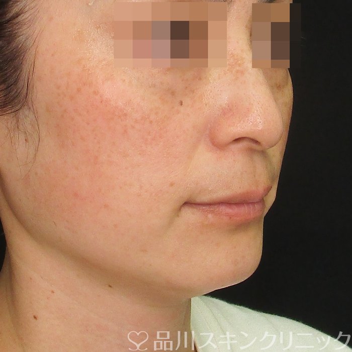 症例NO.75212のBEFORE写真