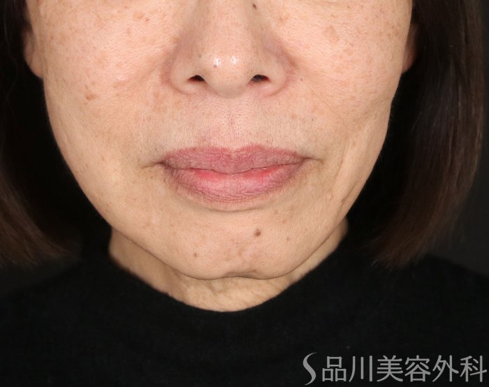 症例NO.72897のBEFORE写真