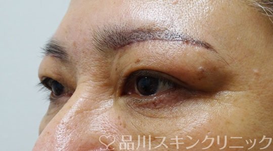 症例NO.69407のAFTER写真