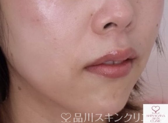 症例NO.68043のAFTER写真