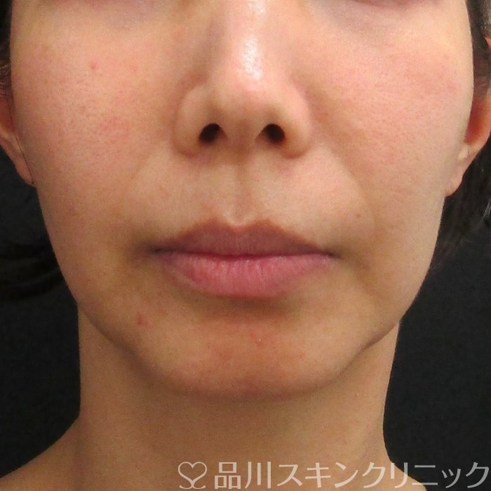 症例NO.75012のBEFORE写真