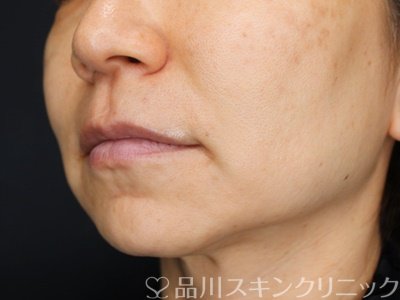 症例NO.70380のBEFORE写真