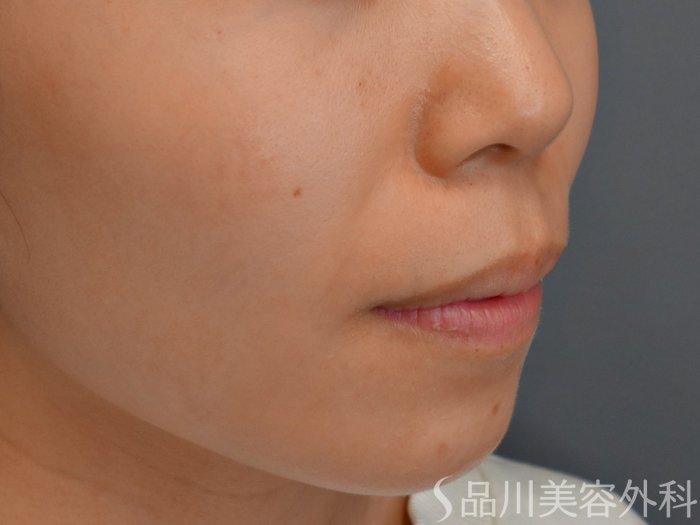 症例NO.73404のBEFORE写真