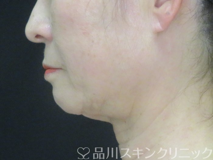 症例NO.69179のBEFORE写真