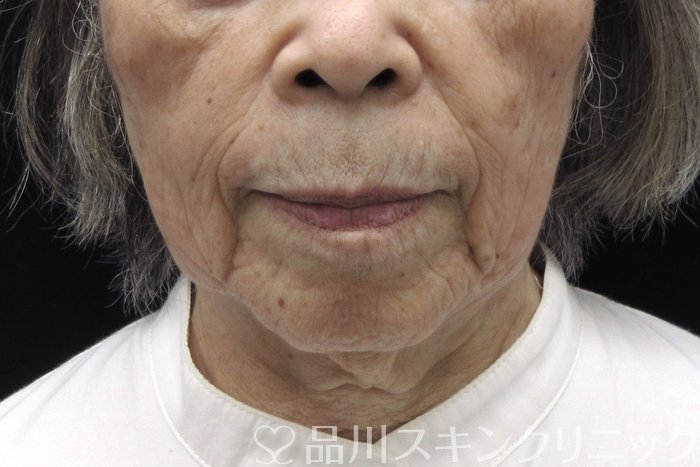 症例NO.74398のBEFORE写真