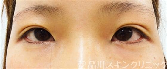 症例NO.32430のBEFORE写真