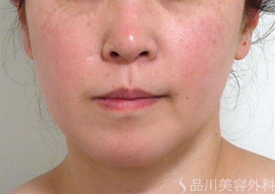 症例NO.35169のBEFORE写真