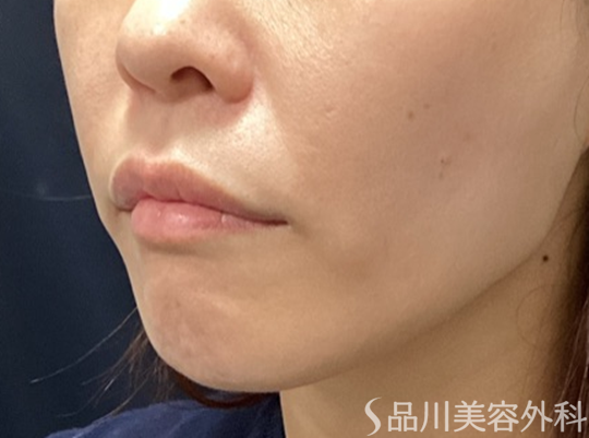 症例NO.74123のAFTER写真