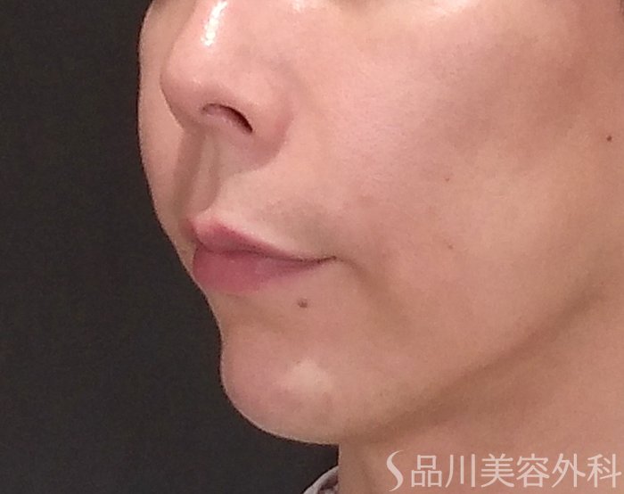 症例NO.70483のAFTER写真