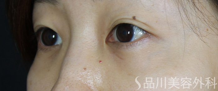 症例NO.69753のAFTER写真