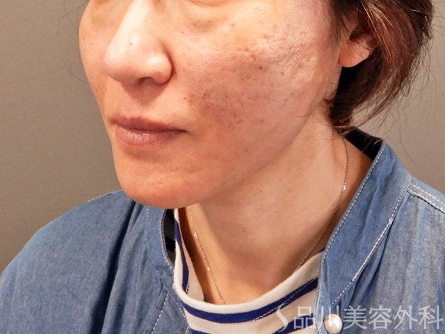 症例NO.69748のAFTER写真