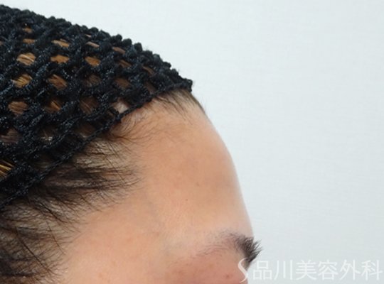 症例NO.72380のBEFORE写真