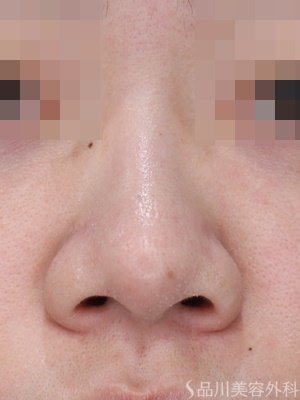 症例NO.70909のBEFORE写真