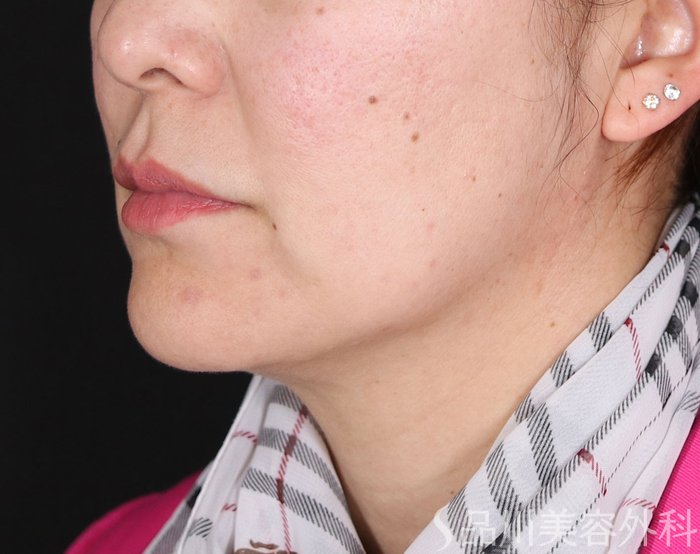 症例NO.73611のBEFORE写真