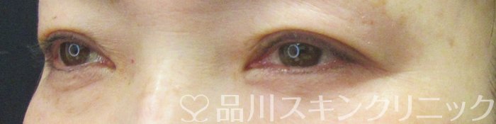 症例NO.70067のAFTER写真